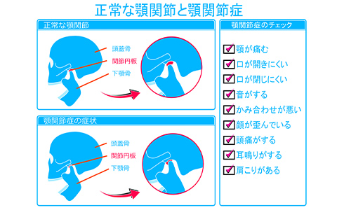 顎関節症