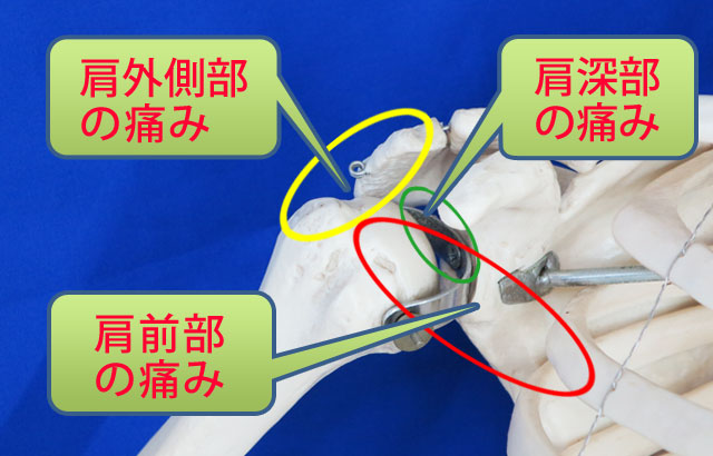 あなたは肩のどの部分に痛みを感じますか