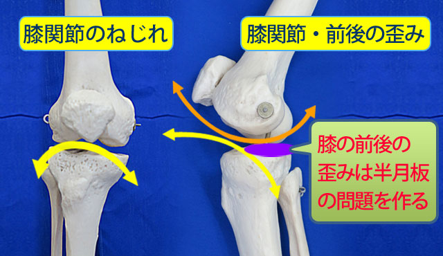 2．中期の段階に進むと膝関節に来ている筋肉群が過緊張すると大腿骨と脛骨の位置が前後にゆがみさらに半月板を後方にずらし膝の痛みが奥へと広がります。