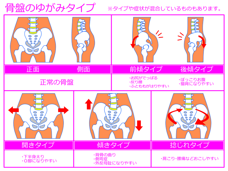 慢性の腰痛